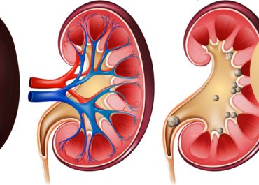 Anatomy of kidney and kidney stones