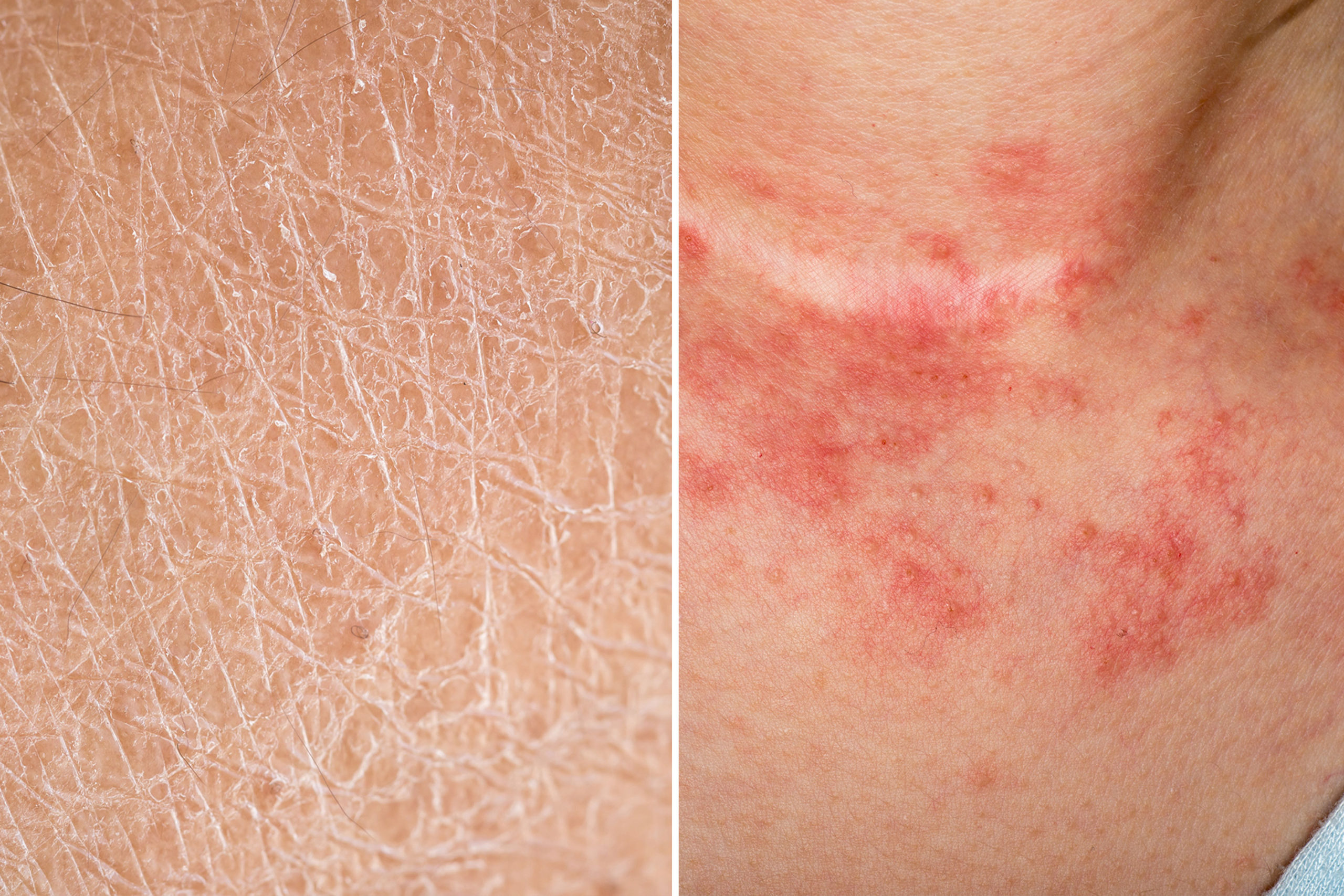 DRY ECZEMA